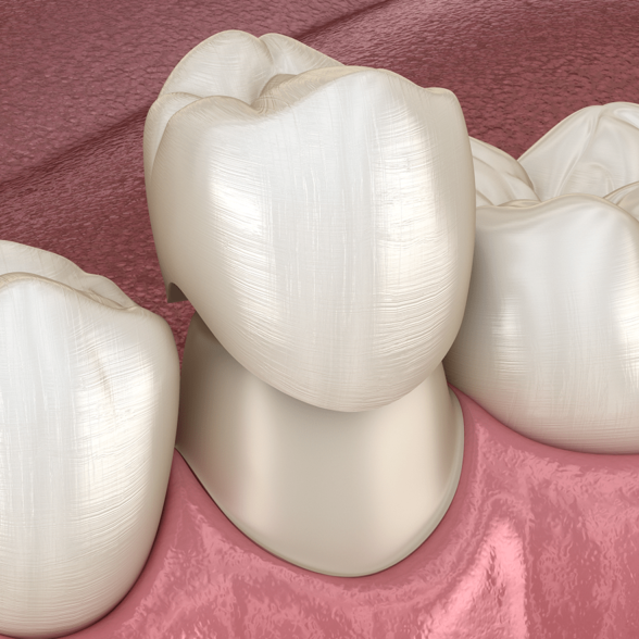 Treatment - platinumorthodontics dental
