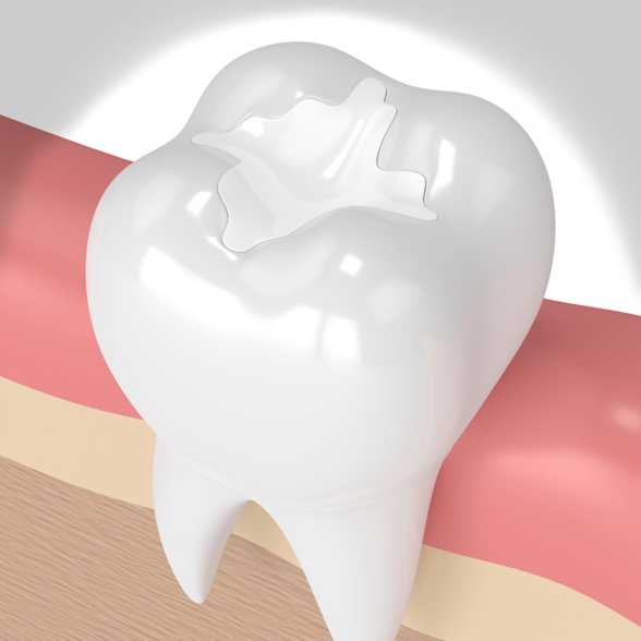 العلاج - تقويم الأسنان البلاتيني