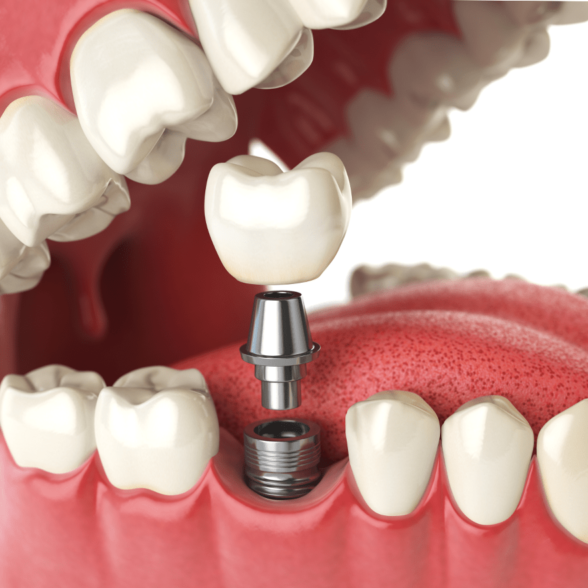 Treatment - platinumorthodontics dental