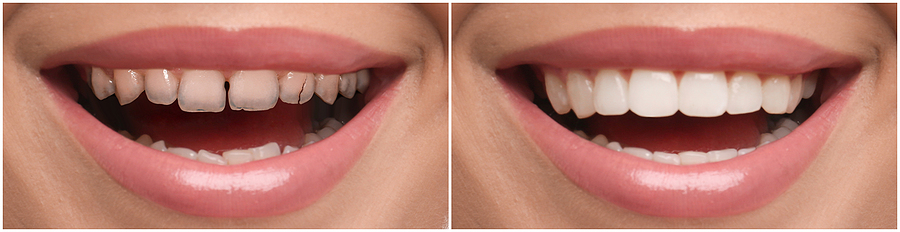 dental veneers