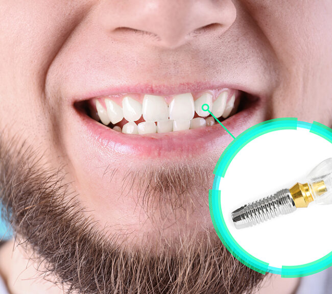 Close up of a white male's lower face and a dental implant. Arrow points from implant to mouth, indicating where the implant would sit after implant surgury.