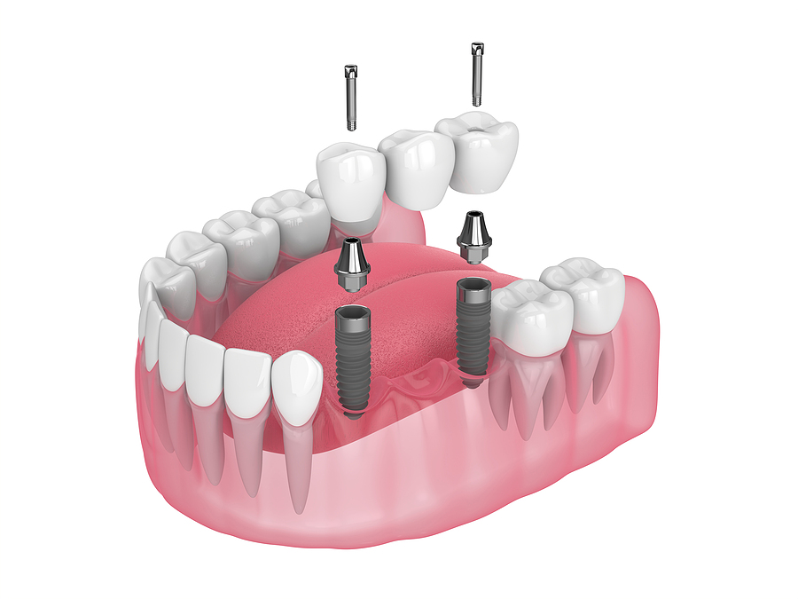 dental bridges vs Dental implants