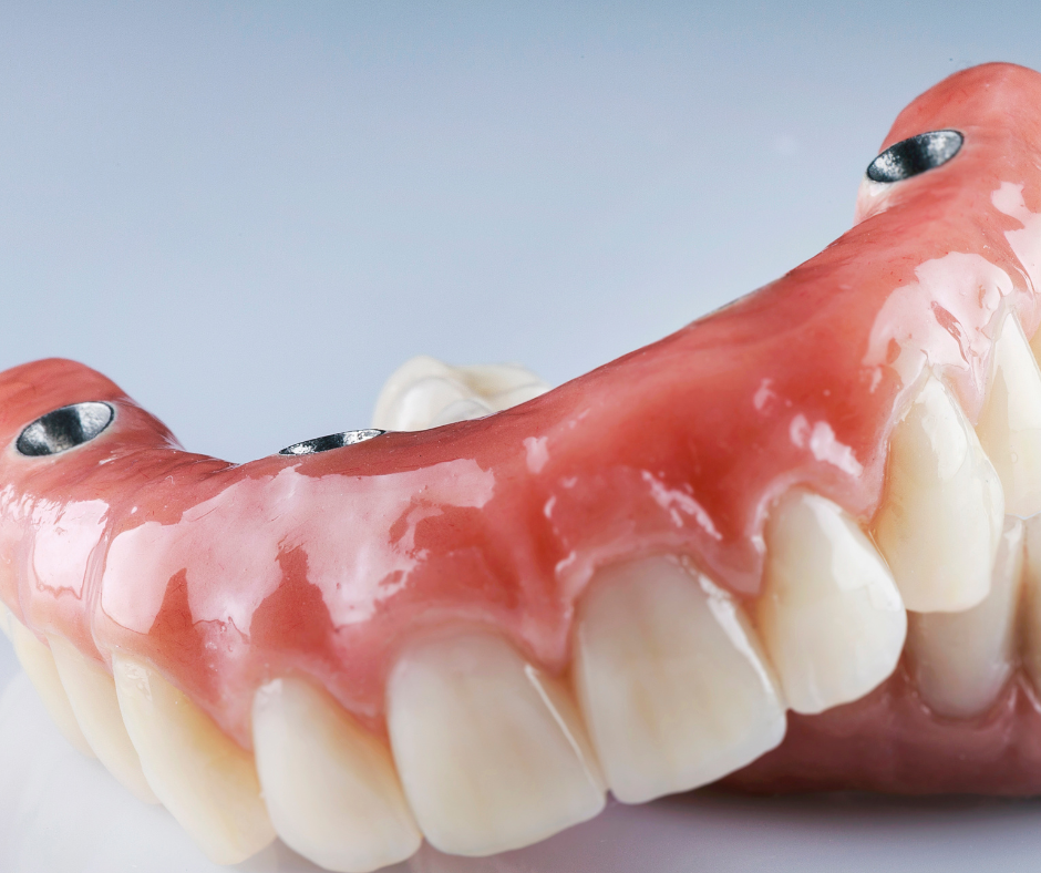 types of dental implants