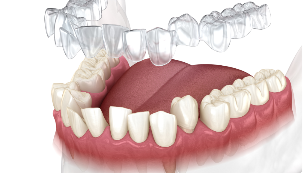 invisalign teeth straightening